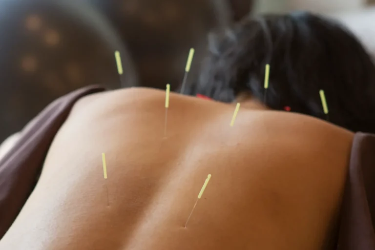 benefici agopuntura